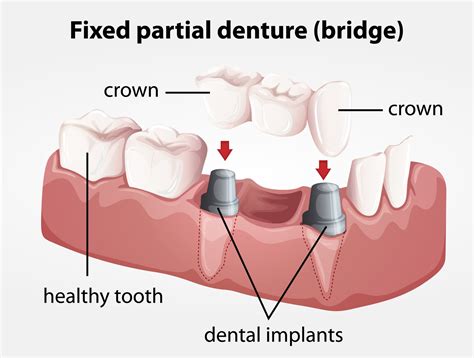 bridge implant in ashford|Ashford Dental Bridges .